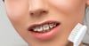 6 pasos para limpiar tus dientes si llevas brackets