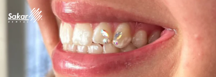 Decoración dental infantil: modas que preocupan a los odontopediatras.