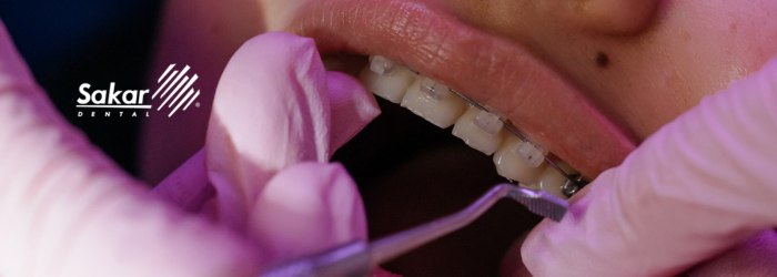 Brackets y lenguaje corporal: cómo cambia tu sonrisa y comunicación