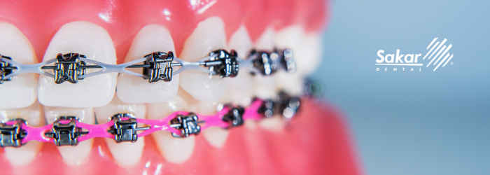 Tu estilo, tu decisión: guía para elegir bien los brackets
